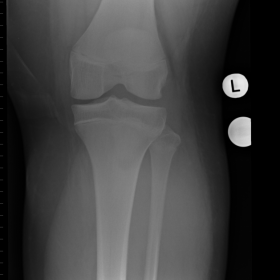 Left Knee. Type III tibial tubercle avulsion fracture.