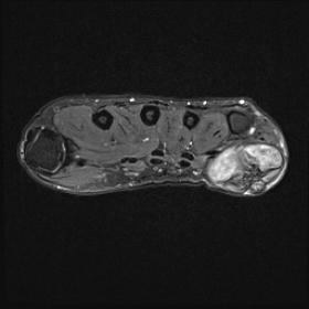 Axial and sagittal MRI STIR sequence shows mass within the ulnar aspect of the left hand. It demonstrates heterogenous high s
