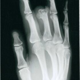 Plain radiograph of the right hand