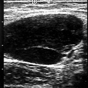 US appearance of cat scratch disease