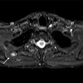 Axial STIR image shows a well-defined oval mass of high signal intensity (arrow) in the space between the minor rhomboid musc
