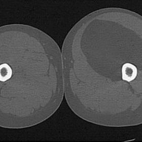 CT of both thighs