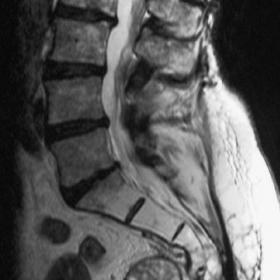 A sagittal T2W MRI scan of the lumbar spine