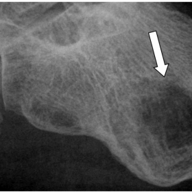 Fig 1. Calcaneum