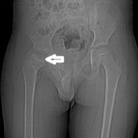 CT Topogram