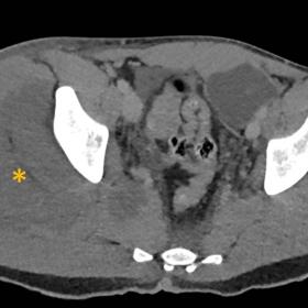 A marked thickening of the proximal quadriceps musculature and gluteal muscles on the right with hypodense areas (*) within
