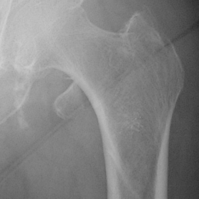 AP view left hip