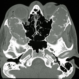 Bone window axial (a) and coronal (b) CT scan through the mid-orbits and maxilla demonstrating maxillary involvement and decreased bilateral orbital volume.