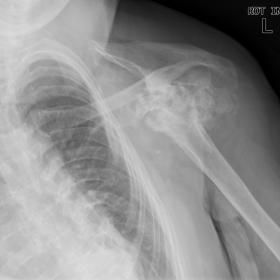 AP radiograph of the left shoulder