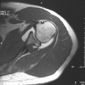T1-weighted spin echo (a,b) and fat saturated (c,d) axial MR arthrogram images