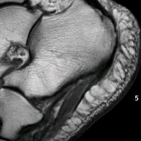 Sagittal T1-weighted MRI