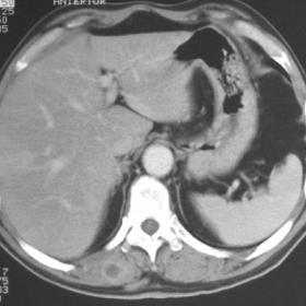 Muscular metastasis from lung adenocarcinoma
