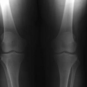 X-ray