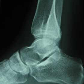 X-rays of the distal tibia and fibula