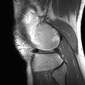 Sagittal, proton-density weighted turbo spin echo image