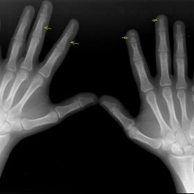 AP view of both hands with coned view of the distal phalanges