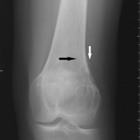 Anteroposterior radiograph of the left knee