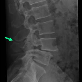 X-ray lumbar spine lateral view shows approximation of spinous processes at L3-L4. Note grade 1 anterolisthesis at L4-L5 with