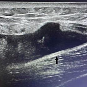 Ultrasound demonstrates a heterogeneous hypoechoic relatively well-defined fluid collection located deep to the hypodermis an