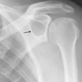 Anteroposterior plain radiograph