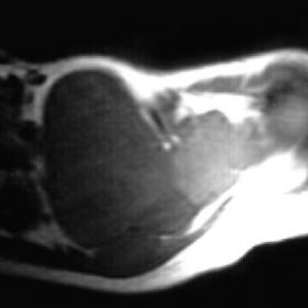 MR imaging appearance of synovial sarcoma
