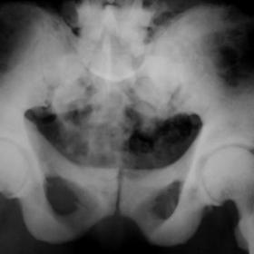 Plain radiography appearance of fluorosis