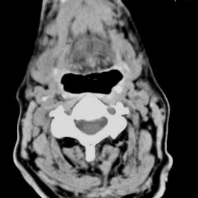 Neck CT