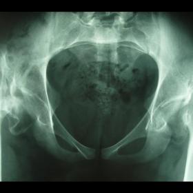 Direct radiography