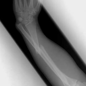 Galeazzi fracture dislocation
