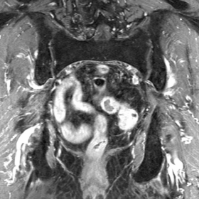 6 weeks after radiotherapy