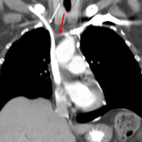 Innonimate veins obstruction