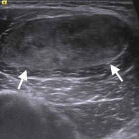 Gray-scale US shows a well-circumscribed mass with predominantly hypoechoic and mildly heterogeneous echotexture (arrows) in 