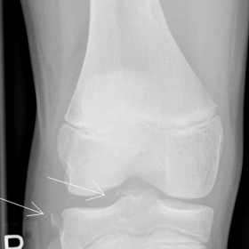 Plain radiograph