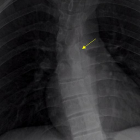 Scoliosis secondary to spinal osteoblastoma
