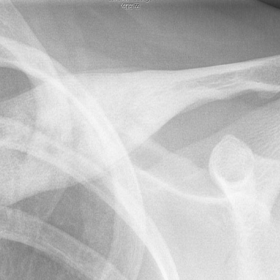 anteroposterior clavicle radiograph